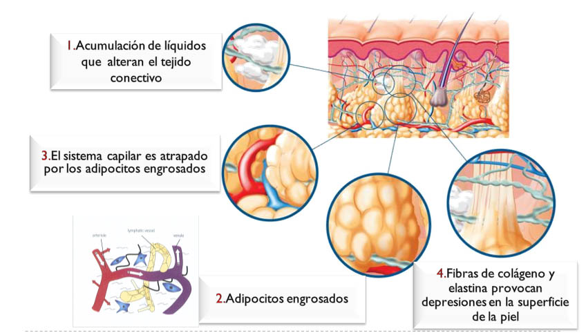 celulitis1