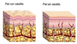 celulitis2